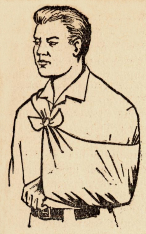 Так прибинтовывают руку к туловищу