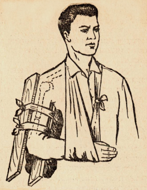 Наложение шины при переломе плеча