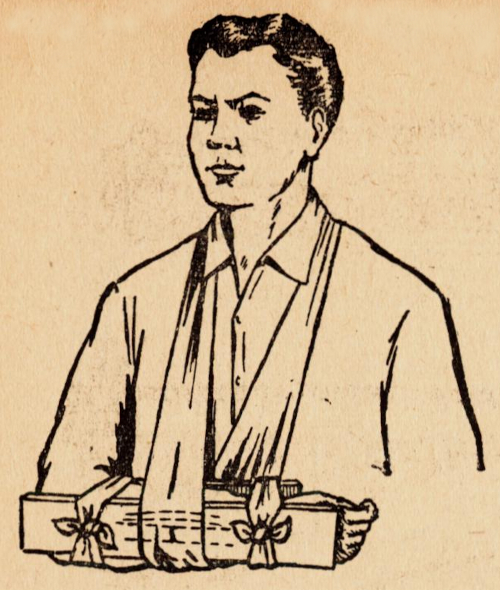 Наложение шины при переломе предплечья