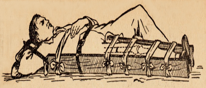 Наложение шины при переломе бедра